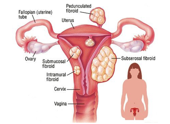 Blocking Blood Flow to Fibroids