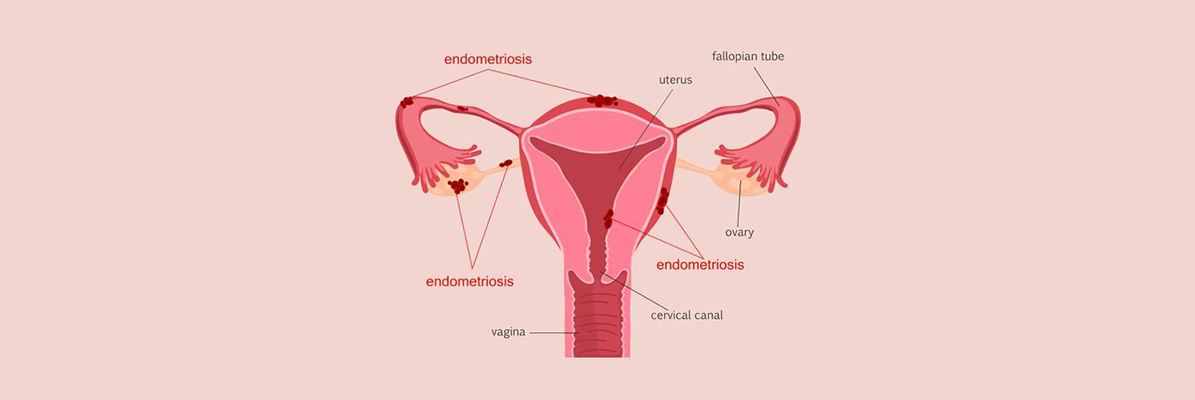 Complexity Of Endometriosis