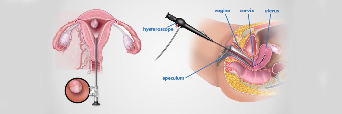 Hysteroscopy In Infertility