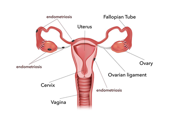 Diagnosis and Treatment of Endometriosis