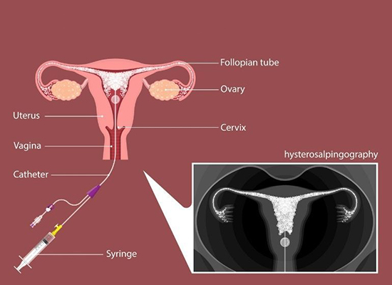 Dye Tube Testing/ HSG