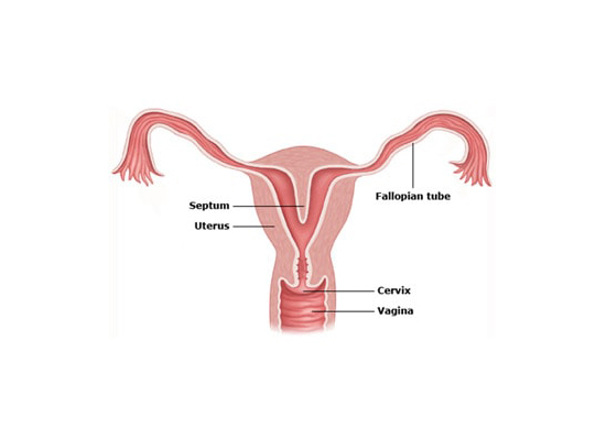 Hysteroscopic Septal Resection and Polypectomy