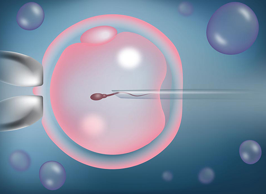 Intracytoplasmic Sperm Injection (ICSI)
