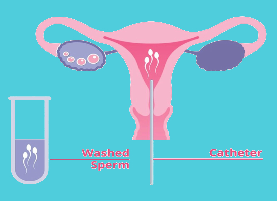 Intrauterine Insemination (IUI)