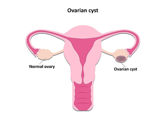 Removal of an Ovarian Cysts